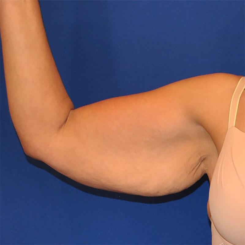Brachioplasty Patient 01 — Before (1 of 6)