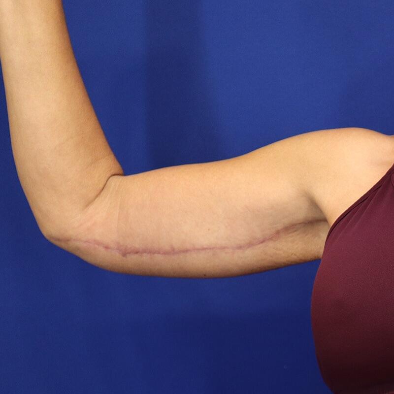 Brachioplasty Patient 01 — After (2 of 6)