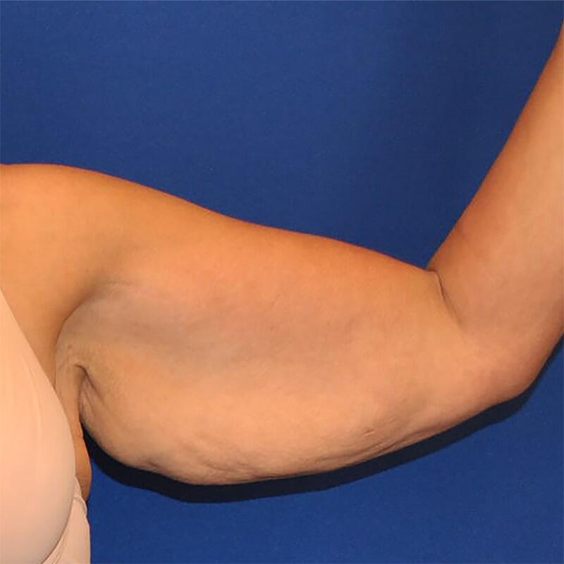 Brachioplasty Patient 01 — Before (3 of 6)
