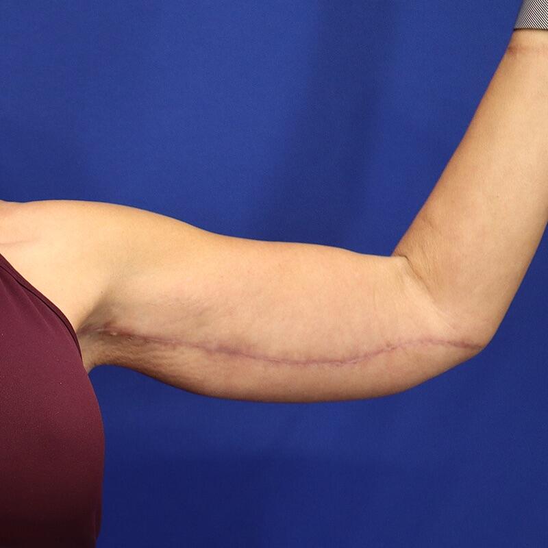 Brachioplasty Patient 01 — After (4 of 6)