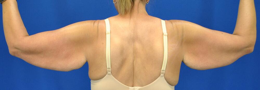 Brachioplasty Patient 01 — Before (5 of 6)