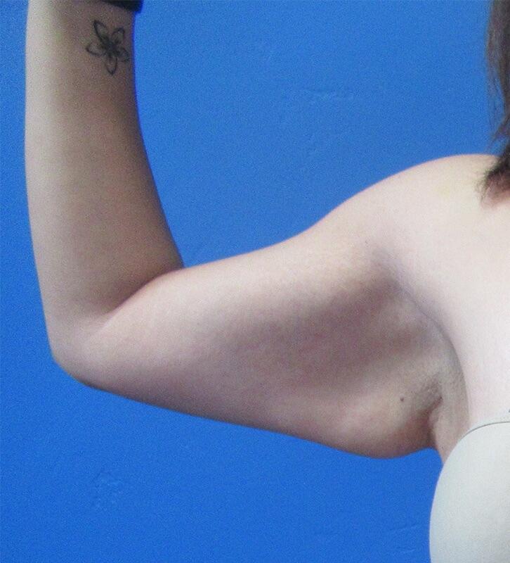 Brachioplasty Patient 02 — Before (1 of 6)