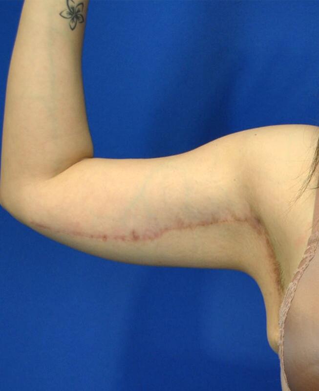 Brachioplasty Patient 02 — After (2 of 6)