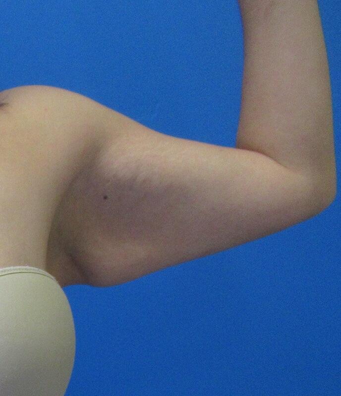 Brachioplasty Patient 02 — Before (3 of 6)