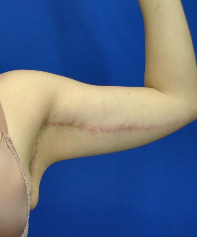 Brachioplasty Patient 02 — After (4 of 6)