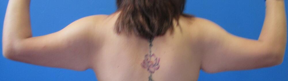 Brachioplasty Patient 02 — Before (5 of 6)