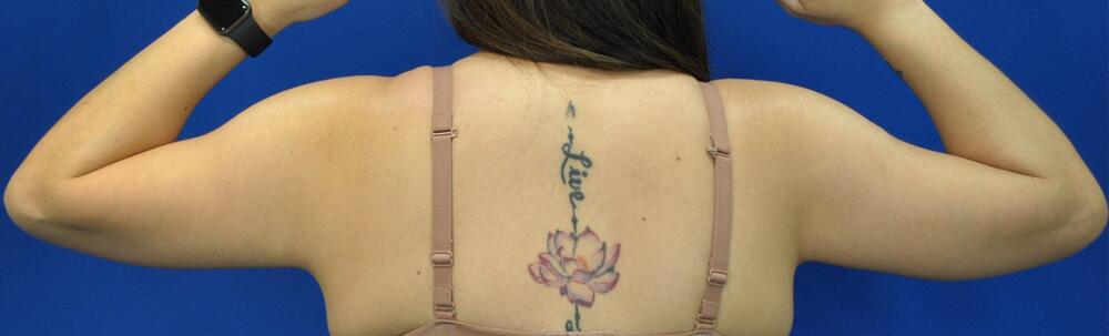 Brachioplasty Patient 02 — After (6 of 6)