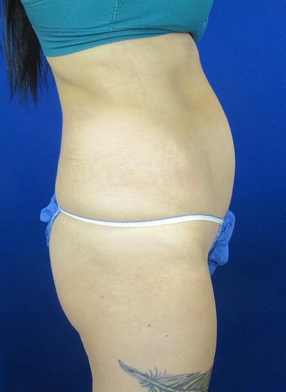 Brazilian Butt Lift Patient 01 — Before (1 of 8)
