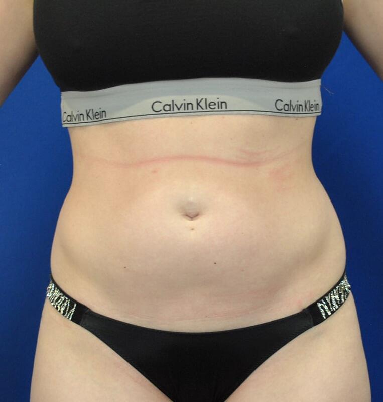 Liposuction Patient 01 — Before (1 of 6)