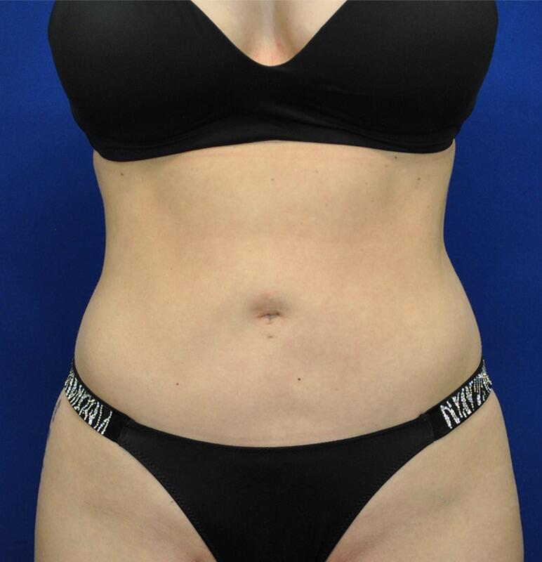 Liposuction Patient 01 — After (2 of 6)