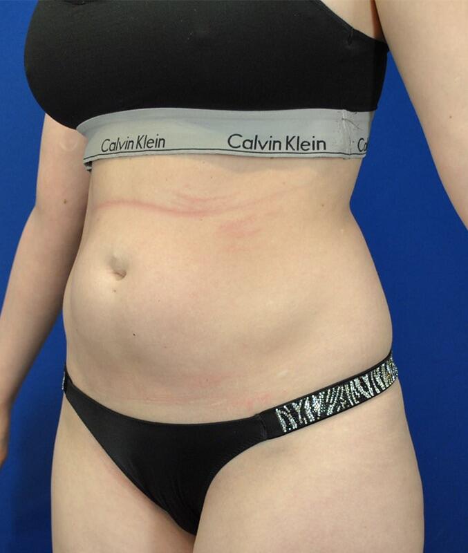 Liposuction Patient 01 — Before (3 of 6)