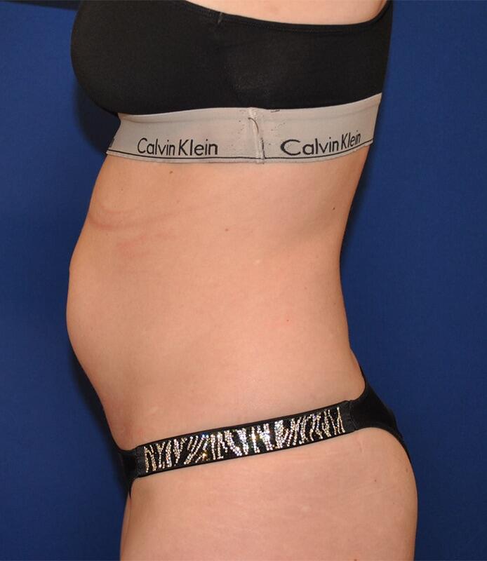 Liposuction Patient 01 — Before (5 of 6)
