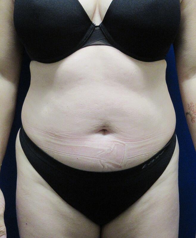 Liposuction Patient 02 — Before (1 of 6)