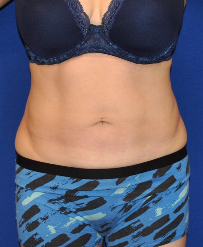 Liposuction Patient 02 — After (2 of 6)
