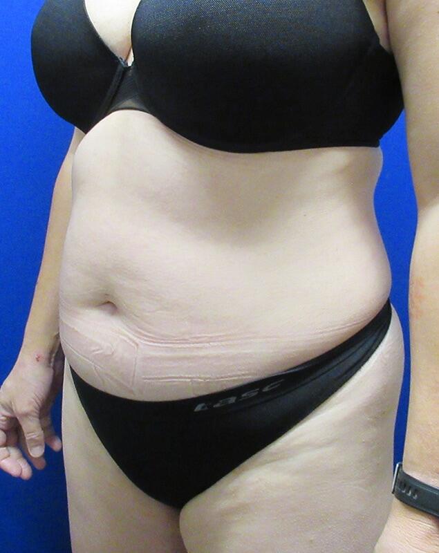 Liposuction Patient 02 — Before (3 of 6)