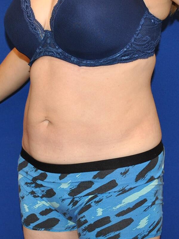 Liposuction Patient 02 — After (4 of 6)