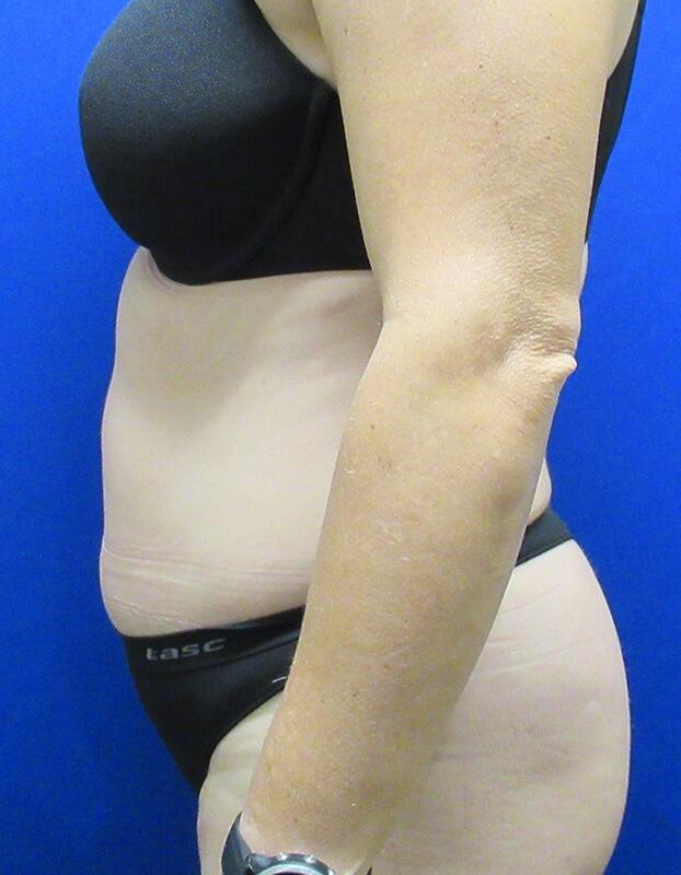 Liposuction Patient 02 — Before (5 of 6)
