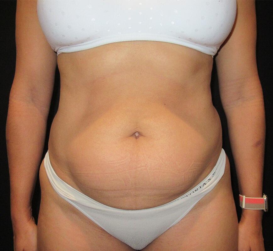 Liposuction Patient 03 — Before (1 of 8)