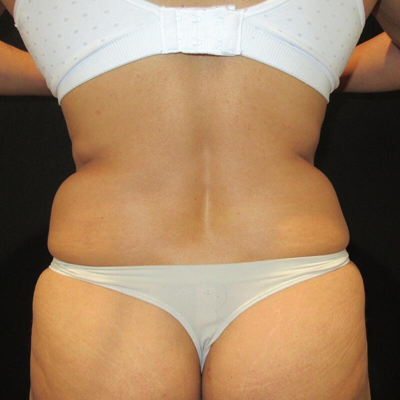 Liposuction Patient 03 — Before (7 of 8)