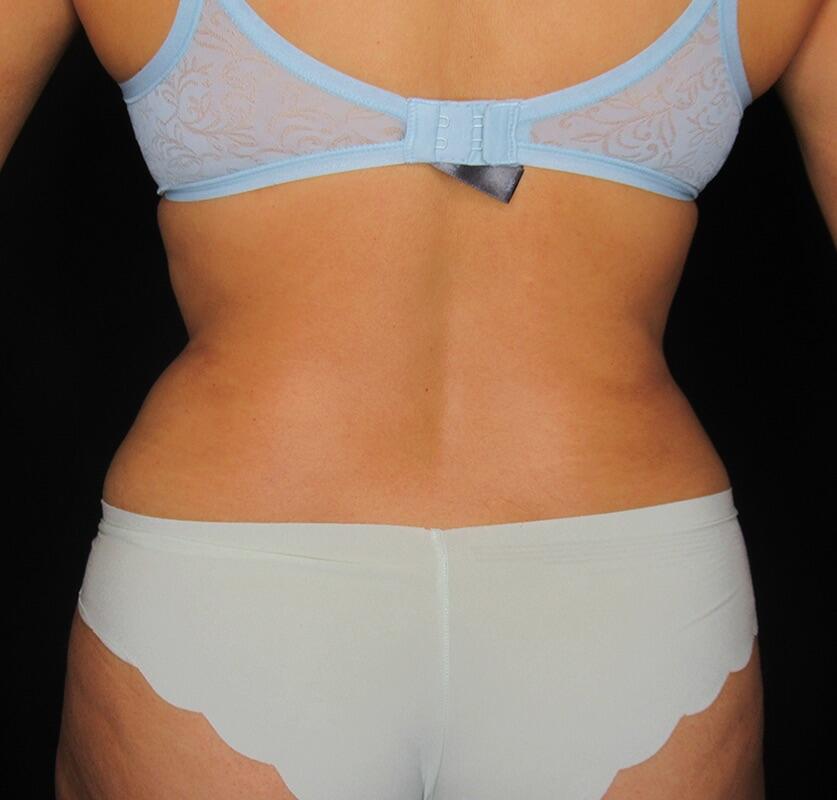 Liposuction Patient 03 — After (8 of 8)