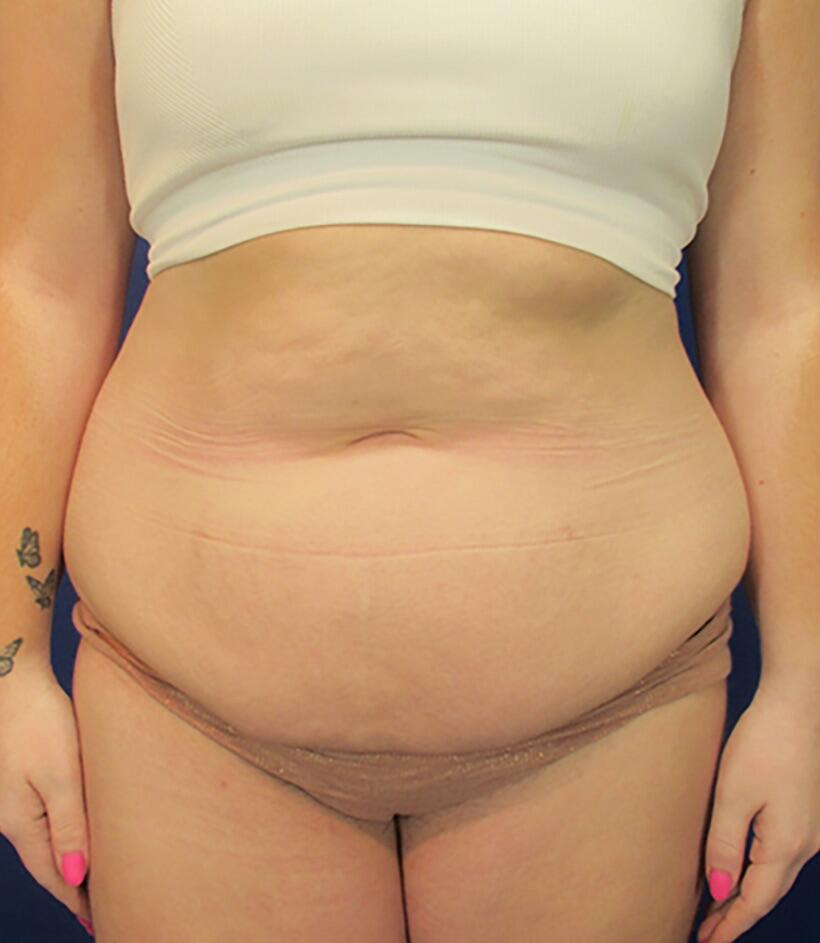 Mini Tummy Tuck Patient 01 — Before (1 of 6)