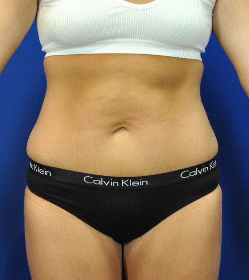 Mini Tummy Tuck Patient 01 — After (2 of 6)