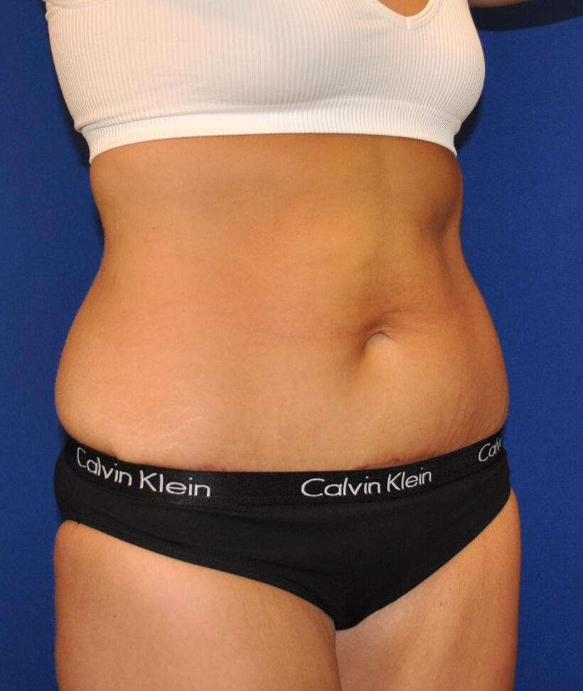 Mini Tummy Tuck Patient 01 — After (4 of 6)