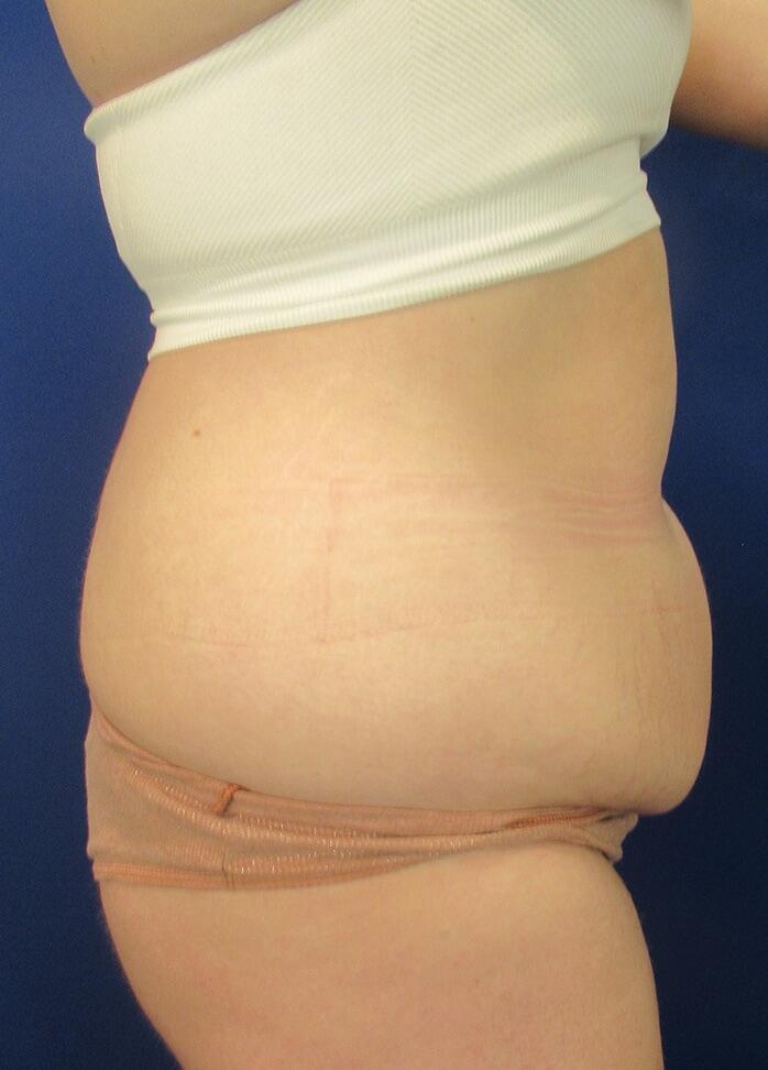 Mini Tummy Tuck Patient 01 — Before (5 of 6)