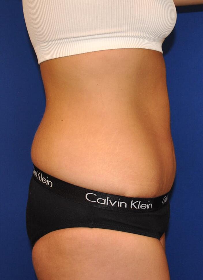 Mini Tummy Tuck Patient 01 — After (6 of 6)