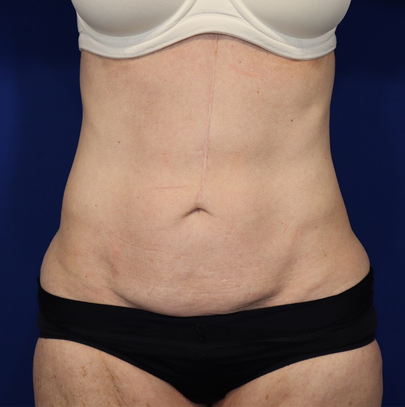 Mini Tummy Tuck Patient 02 — Before (1 of 6)
