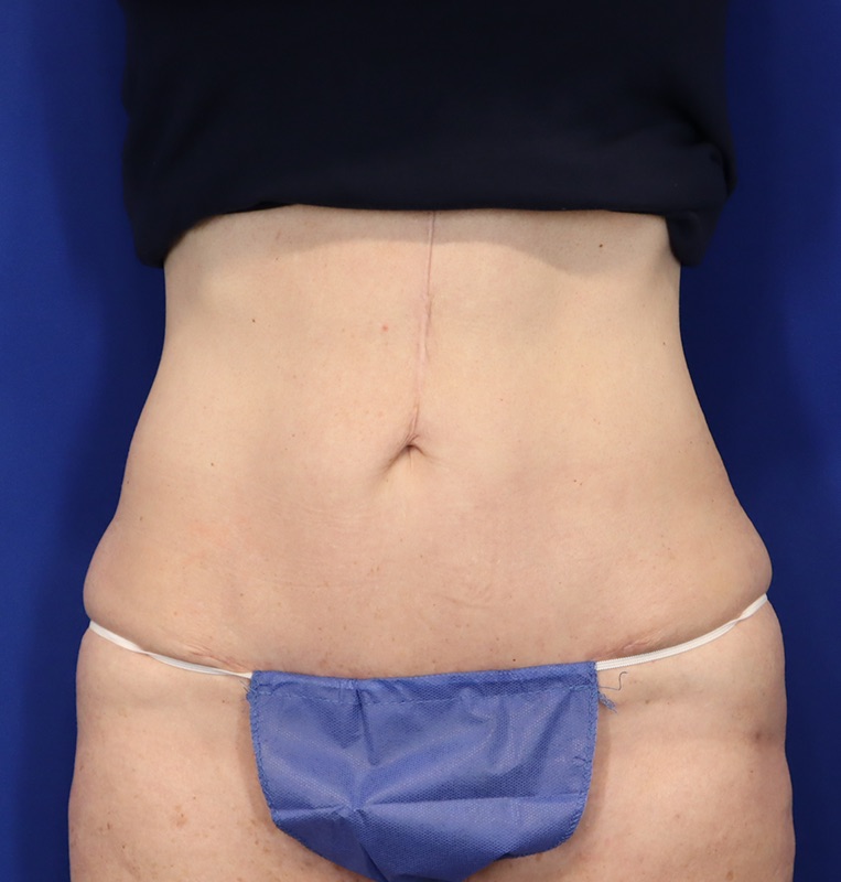 Mini Tummy Tuck Patient 02 — After (2 of 6)