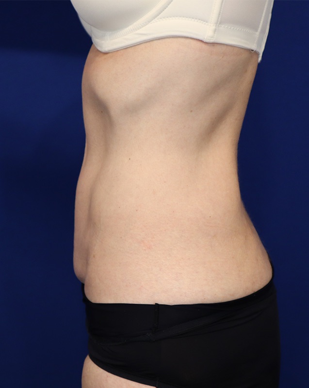 Mini Tummy Tuck Patient 02 — Before (5 of 6)