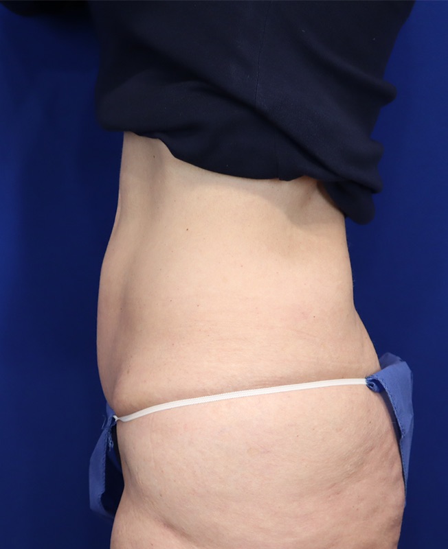 Mini Tummy Tuck Patient 02 — After (6 of 6)