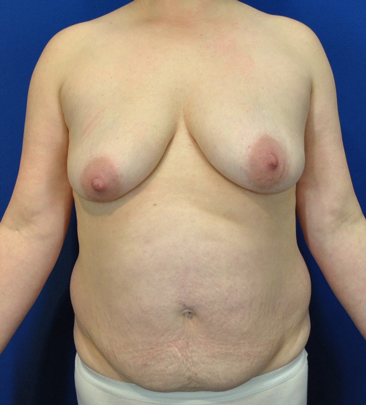 Mommy Makeover Patient 03 — Before (1 of 6)