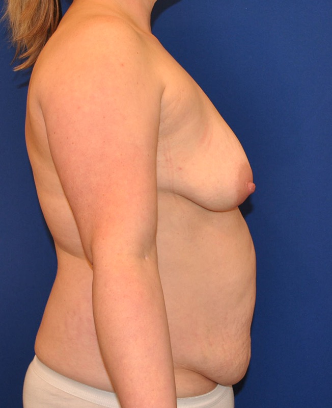 Mommy Makeover Patient 03 — Before (5 of 6)