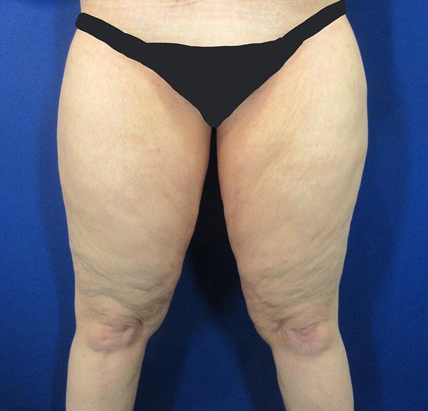 Thighplasty Patient 01 — Before (1 of 2)