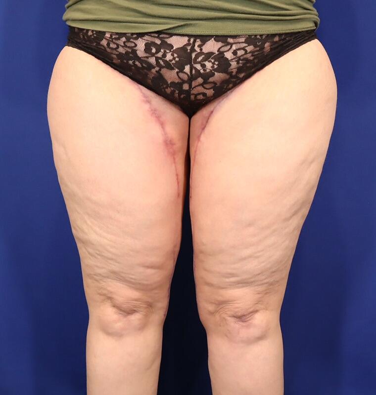 Thighplasty Patient 01 — After (2 of 2)