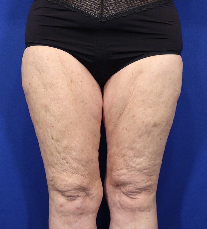 Thighplasty Patient 02 — Before (1 of 2)