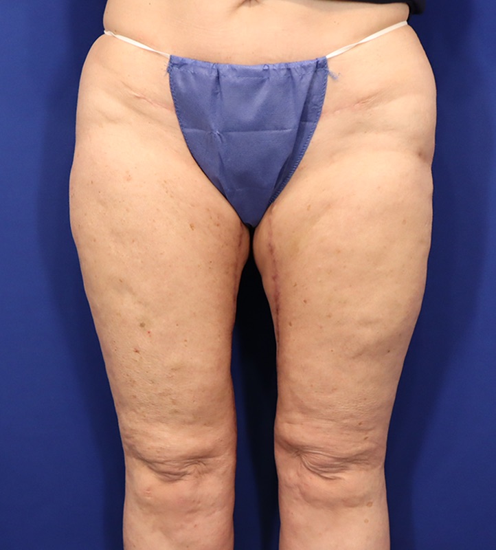Thighplasty Patient 02 — After (2 of 2)
