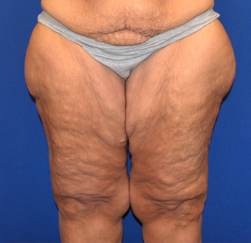 Thighplasty Patient 03 — Before (1 of 4)