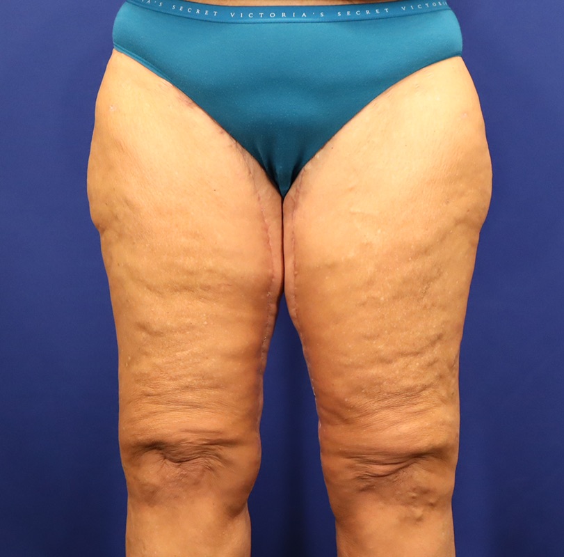 Thighplasty Patient 03 — After (2 of 4)