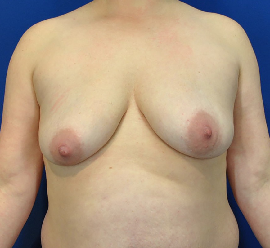 Breast Augmentation Mastopexy Patient 01 — Before (1 of 6)