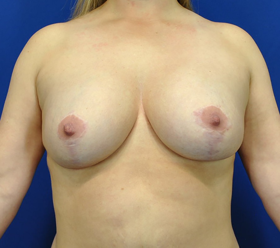 Breast Augmentation Mastopexy Patient 01 — After (2 of 6)