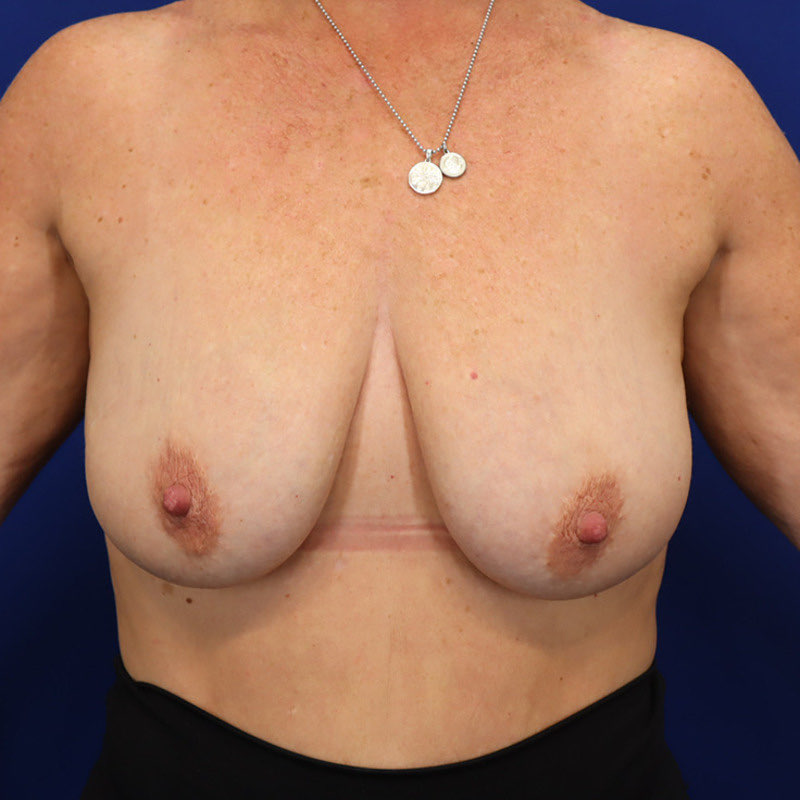 Breast Augmentation Mastopexy Patient 03 — Before (1 of 6)
