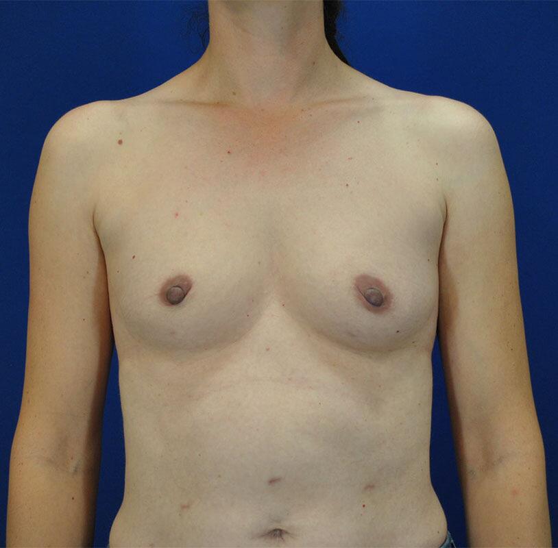 Breast Augmentation Patient 05 — Before (1 of 6)