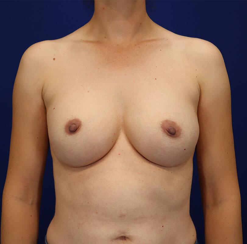 Breast Augmentation Patient 05 — After (2 of 6)