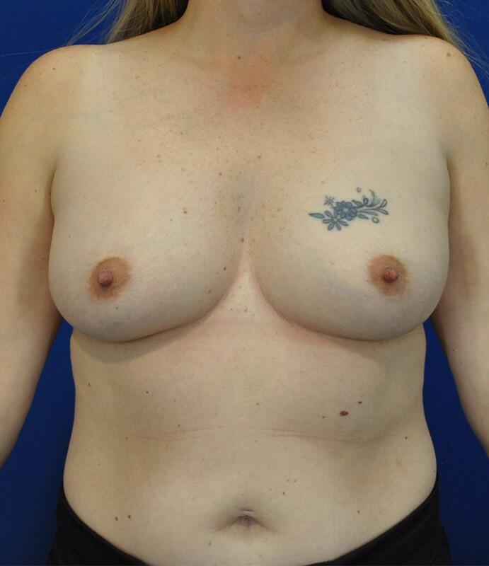 Breast Augmentation Patient 06 — Before (1 of 6)