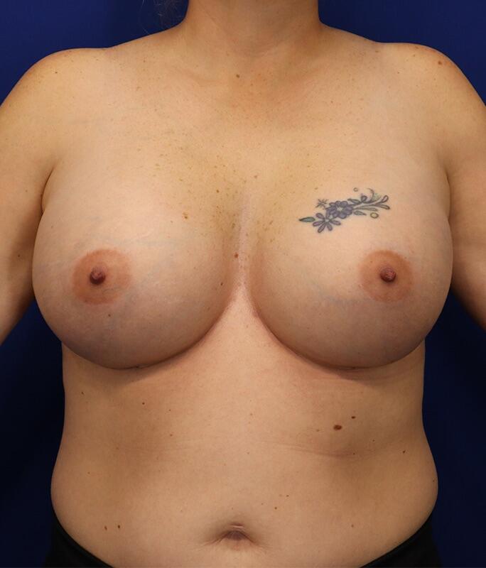 Breast Augmentation Patient 06 — After (2 of 6)