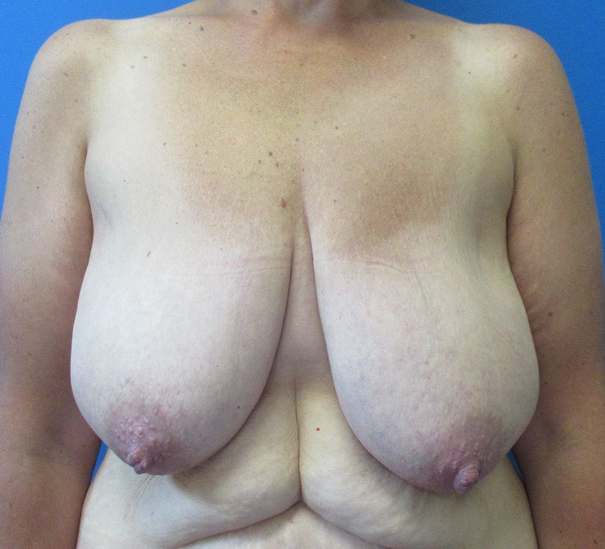 Mastopexy Patient 03 — Before (1 of 6)