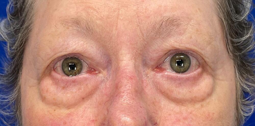Blepharoplasty Patient 01 — Before (1 of 6)
